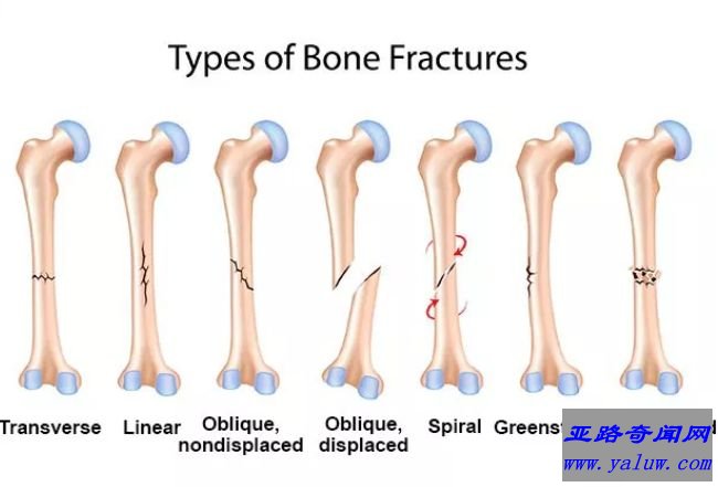 骨折的原因