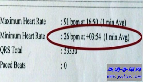 世界上心跳最慢的人，英国老人的心跳速率每分钟26下（平均两秒一次）