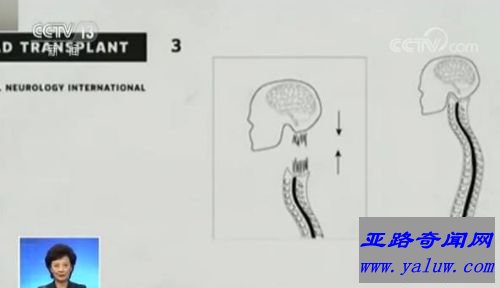 中国教授完成全球首例人类换头术 历时18个小时