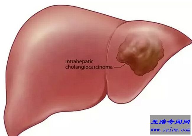 肝内胆管细胞癌