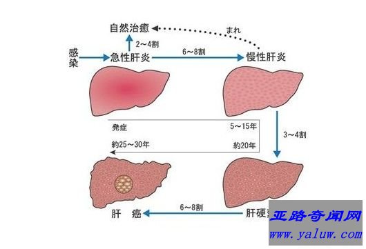 得了肝炎就会变成肝癌